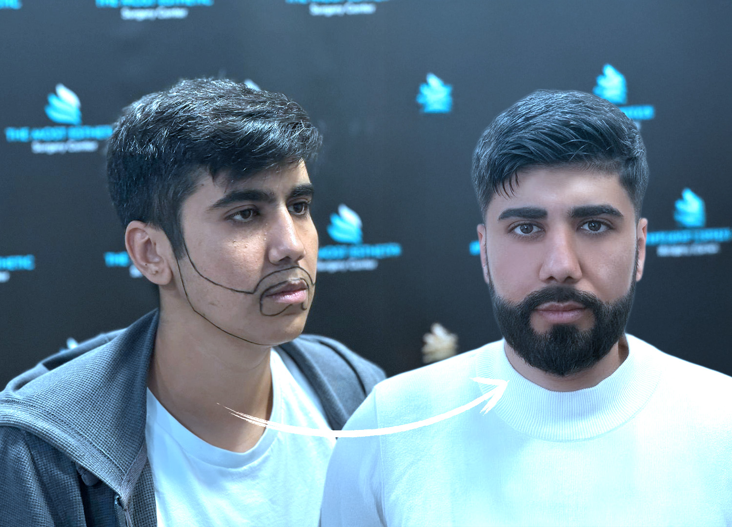 Professional Beard Transplant Surgery