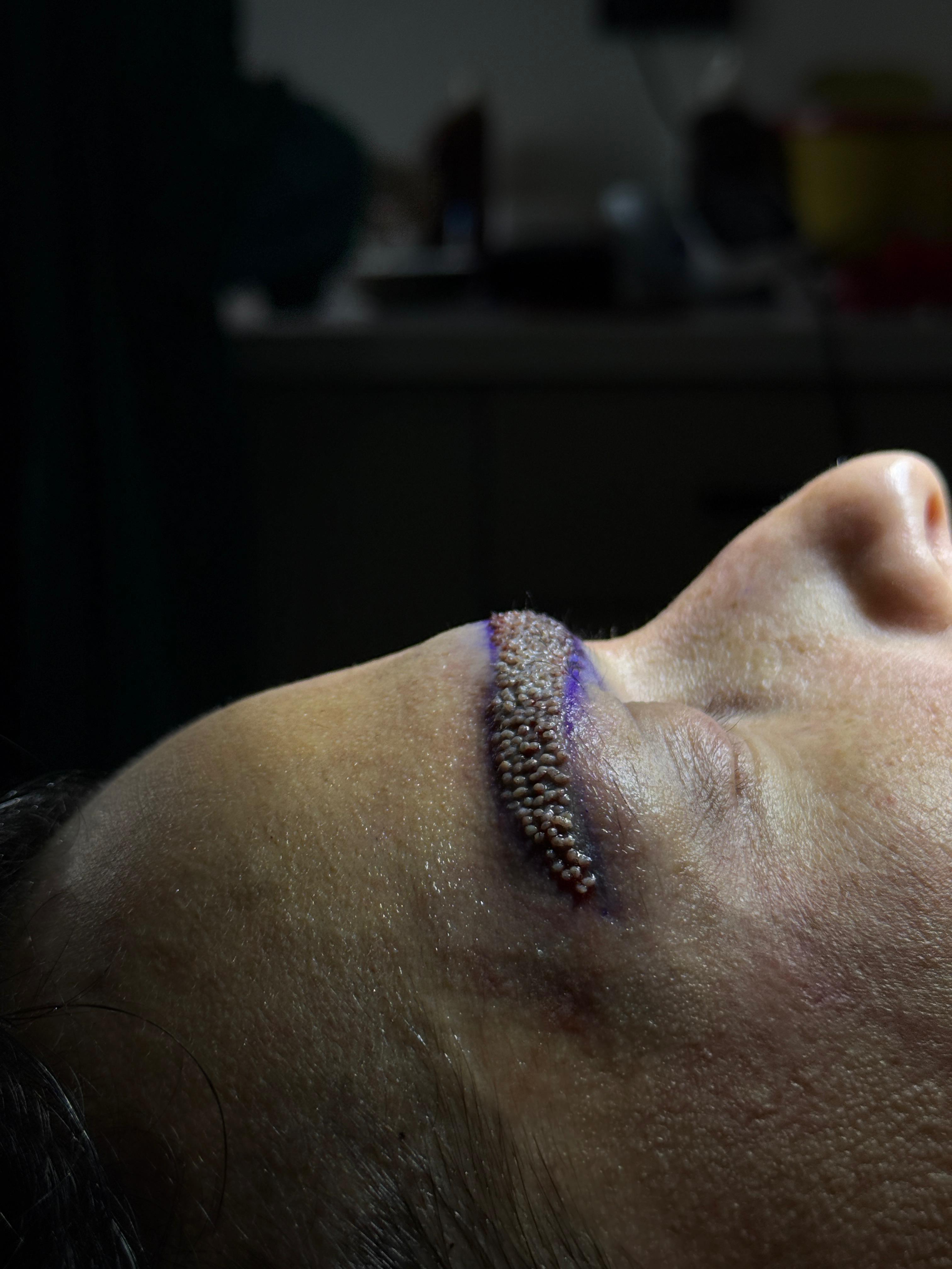 Precise Implantation Procedure