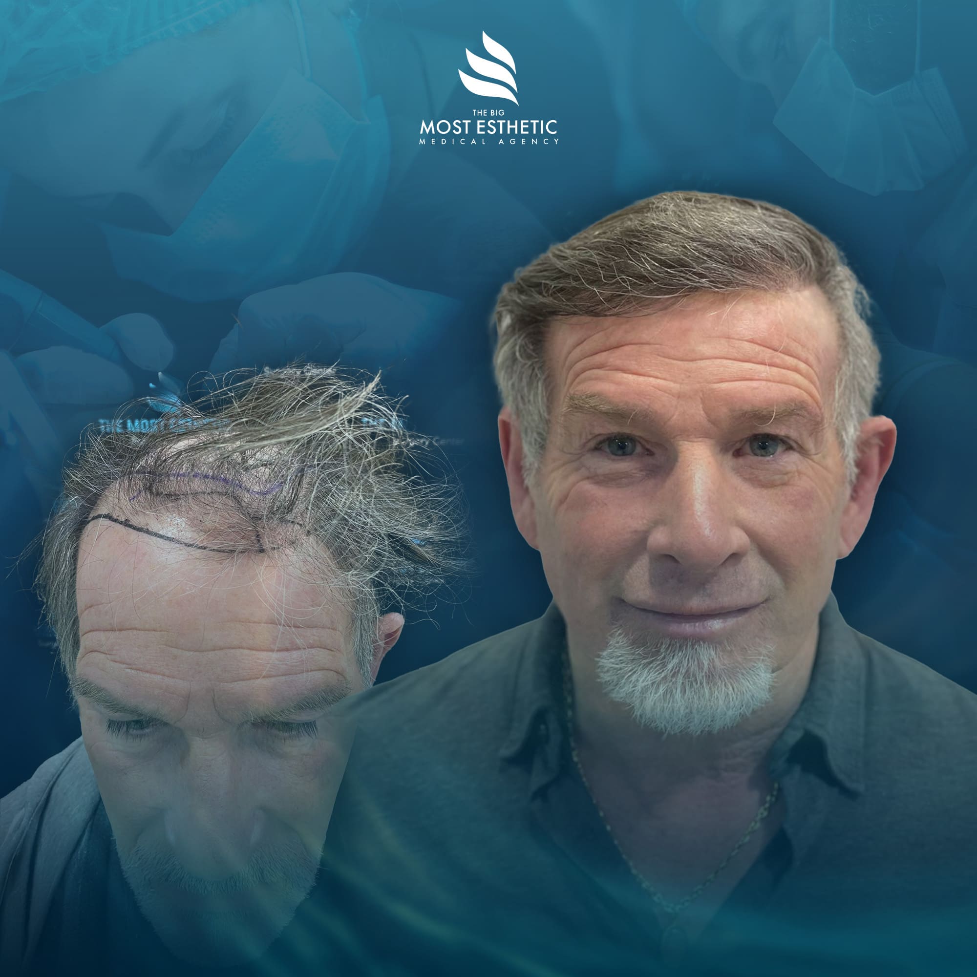 Advanced Density Restoration