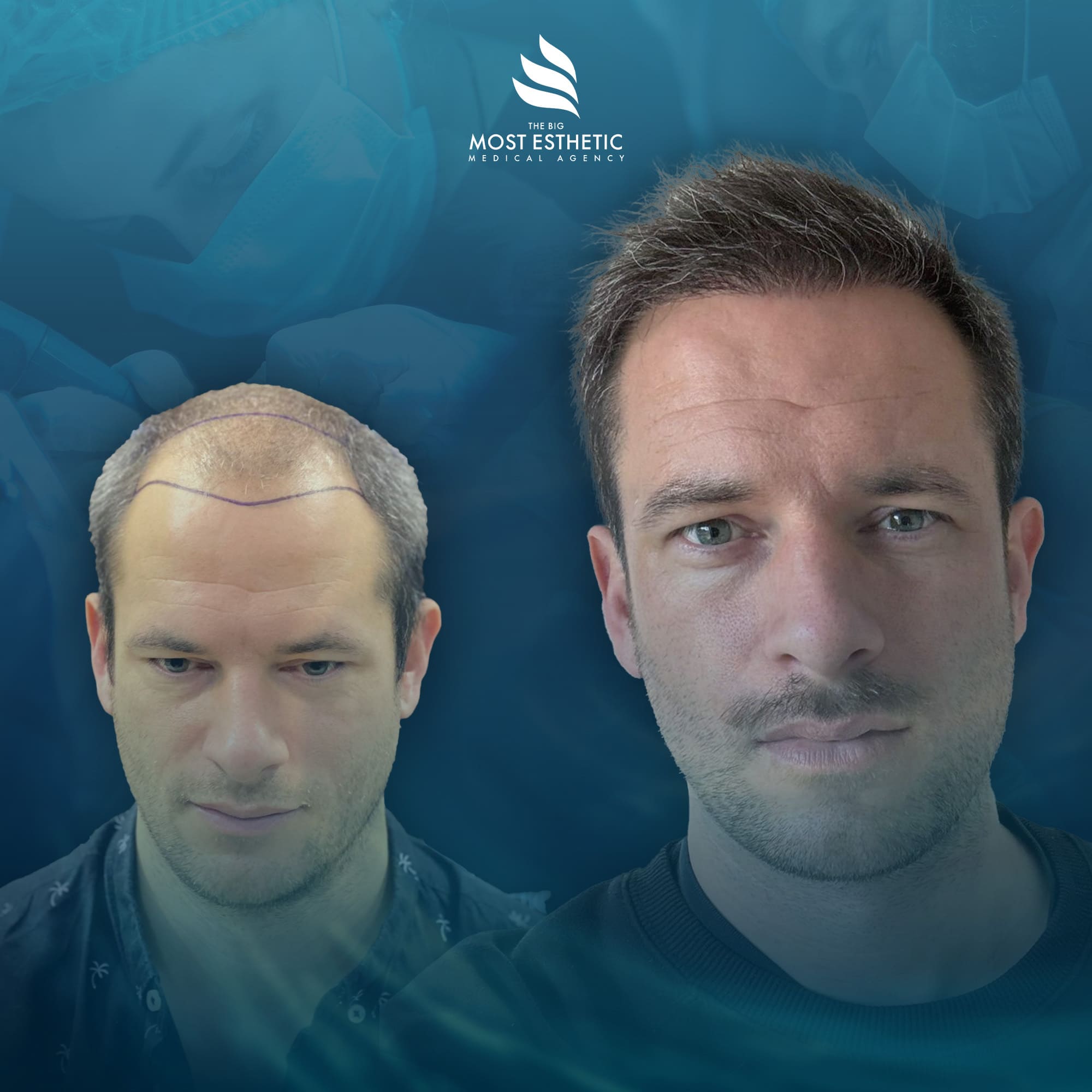 Natural Hairline Enhancement