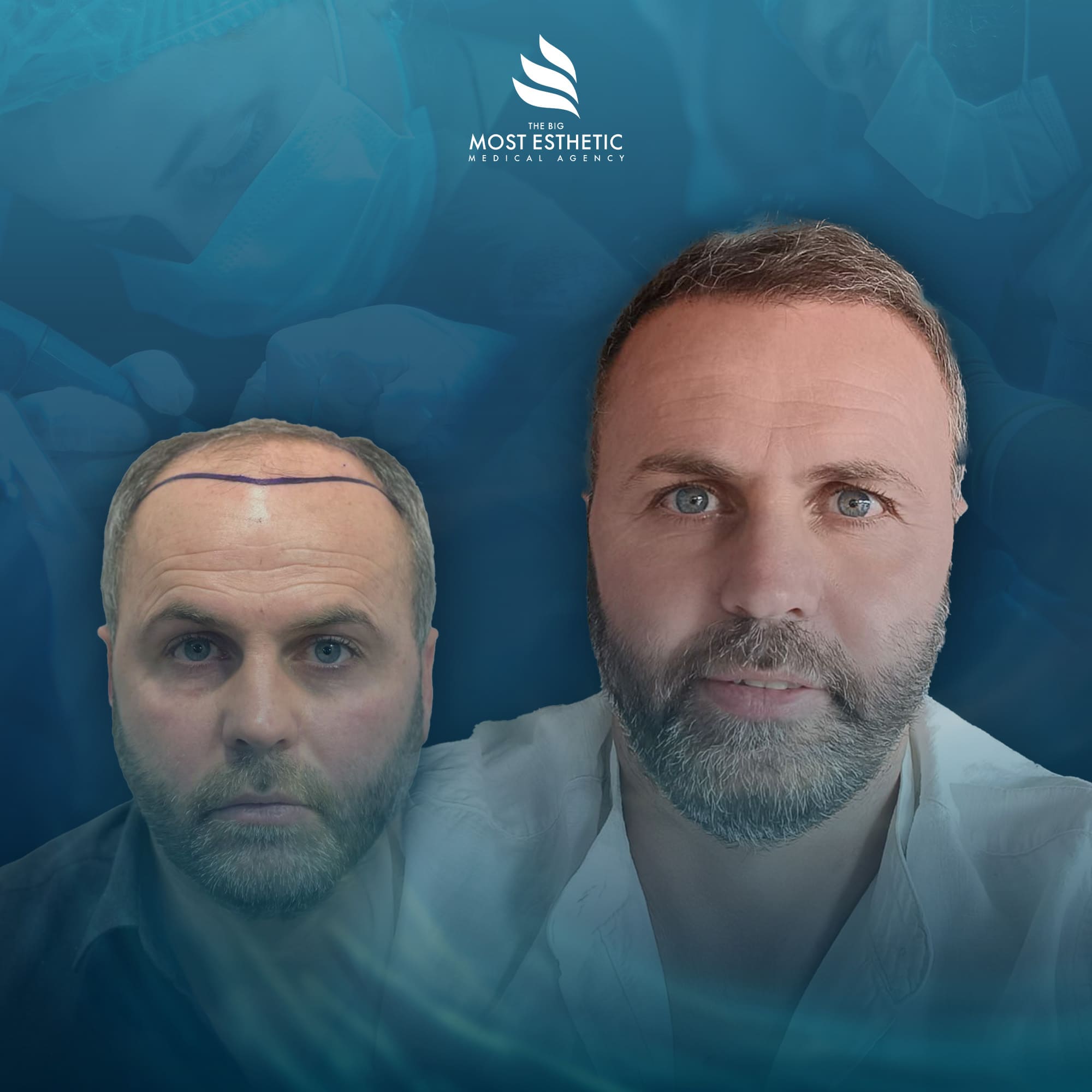 Full Coverage Restoration