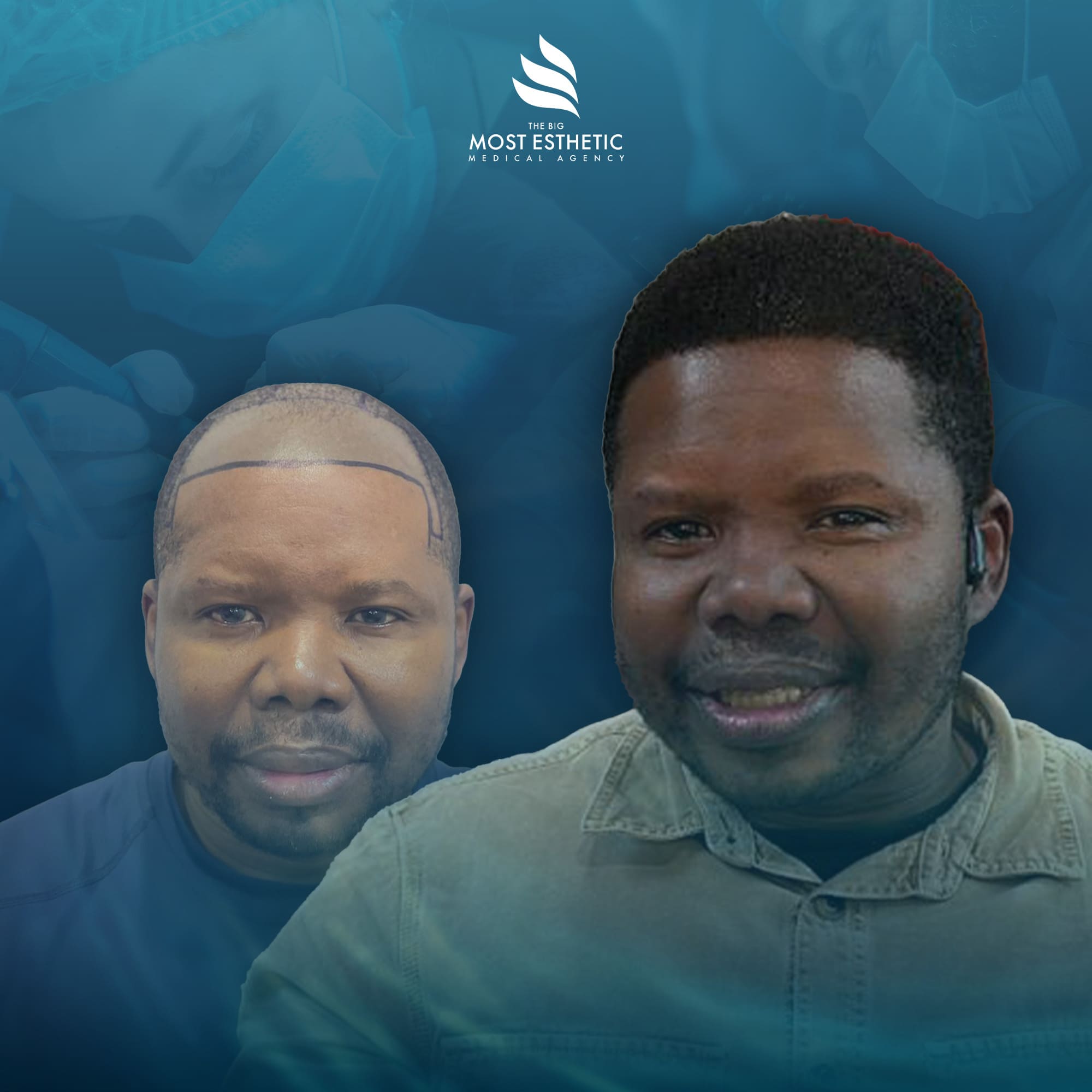 Natural Hairline Reconstruction