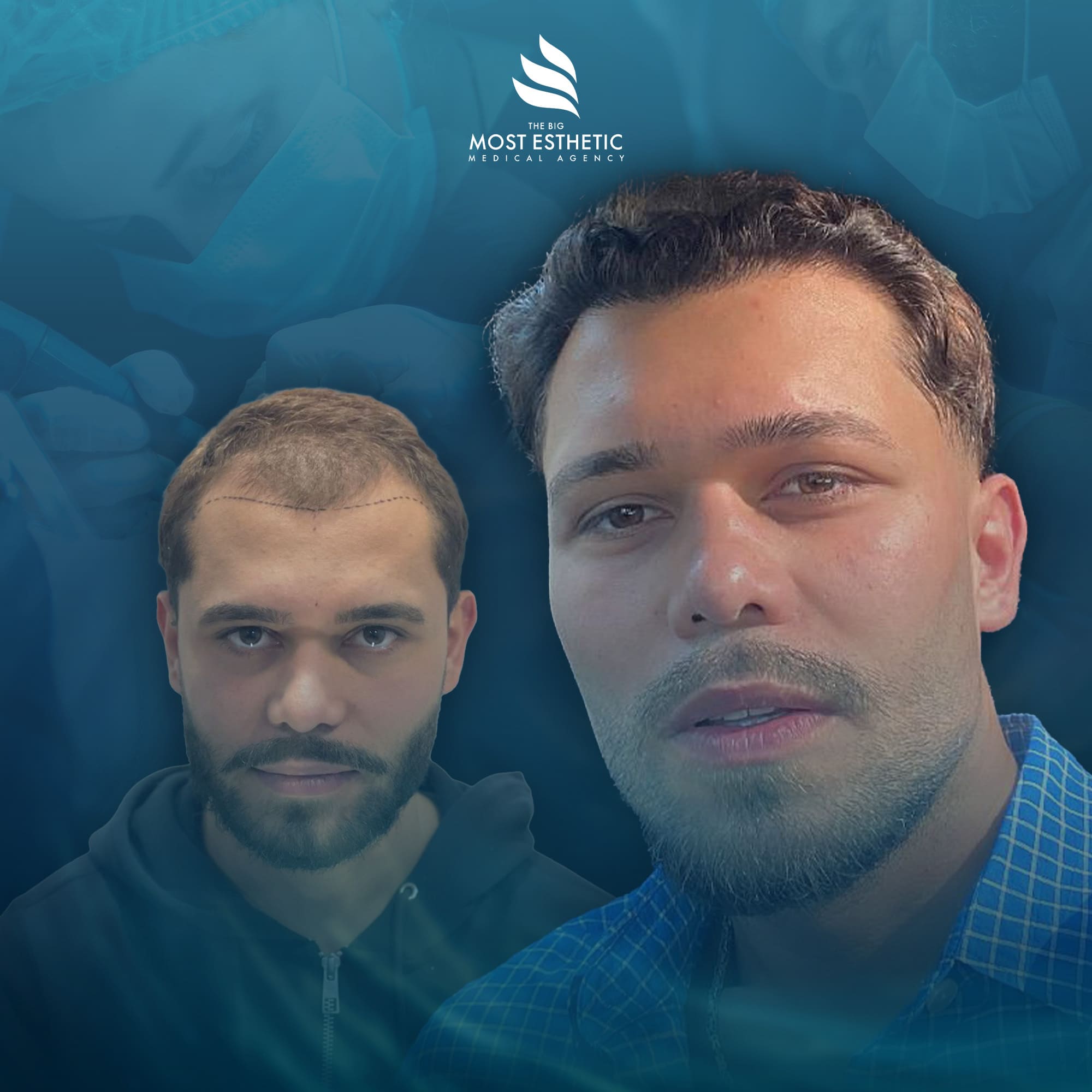 Beard Transplant Transformation