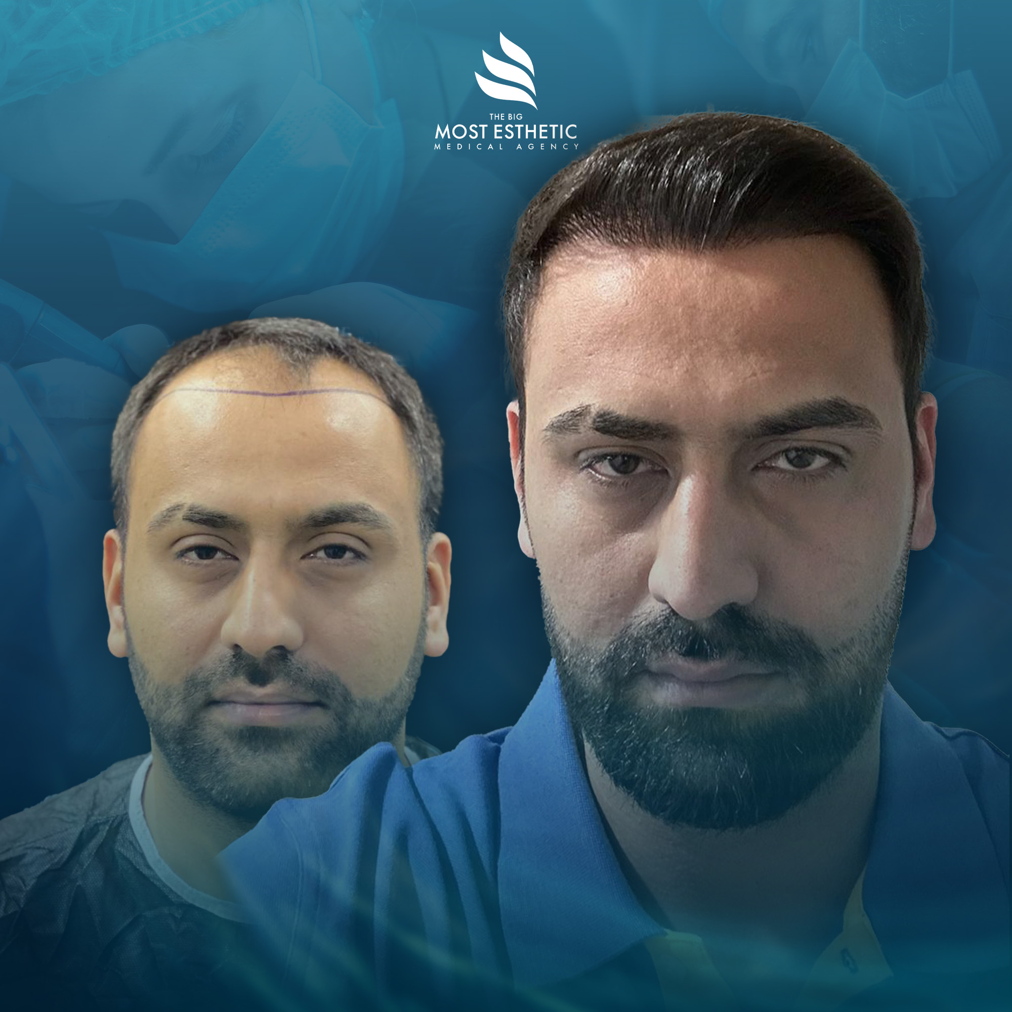 Complete Hair Restoration