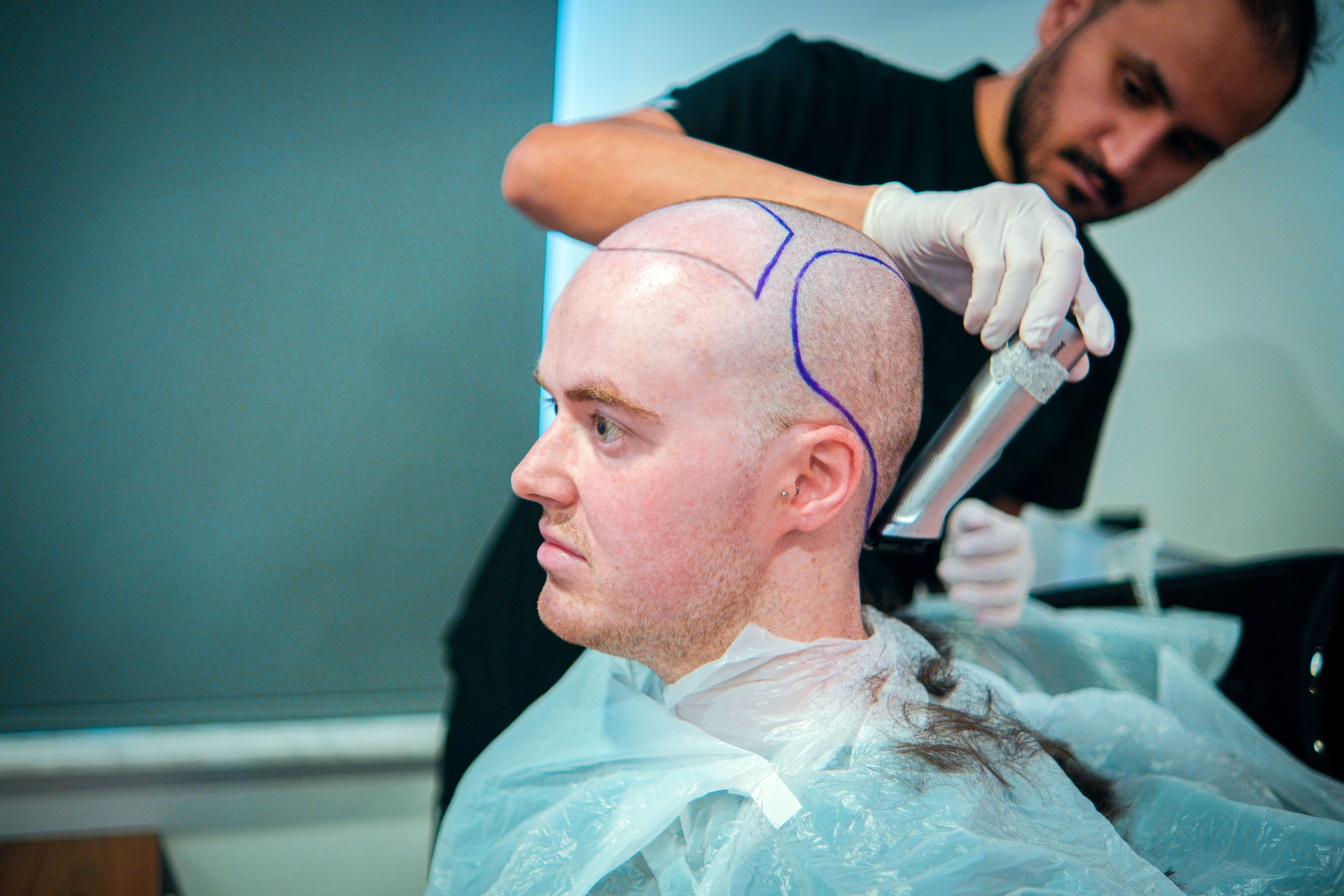 Hairline Design and Planning